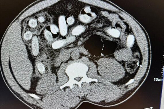 Röntgenaufnahme: Bodypacks mit Kokain im Magen-Darm-Trakt eines festgenommenen Italieners.