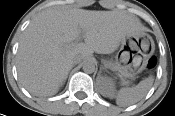 Röntgenbild zeigt Drogenpäckchen im Magen eines niederländischen Drogenkurieren am Flughafen Köln.