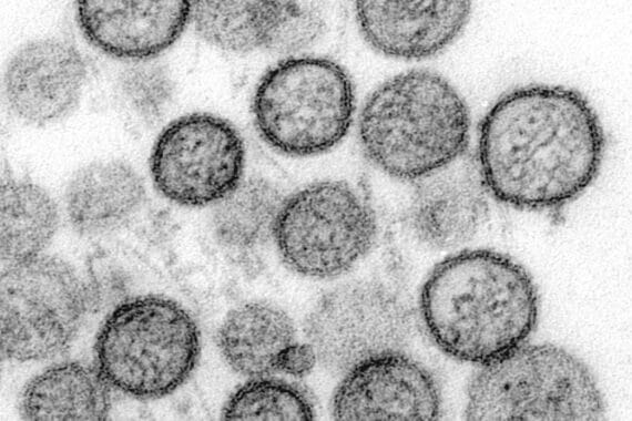 Passagierschiff unter Quarantäne, Hantavirus-Infektionen, medizinische Maßnahmen, Besorgnis um Sicherheit von Reisenden.